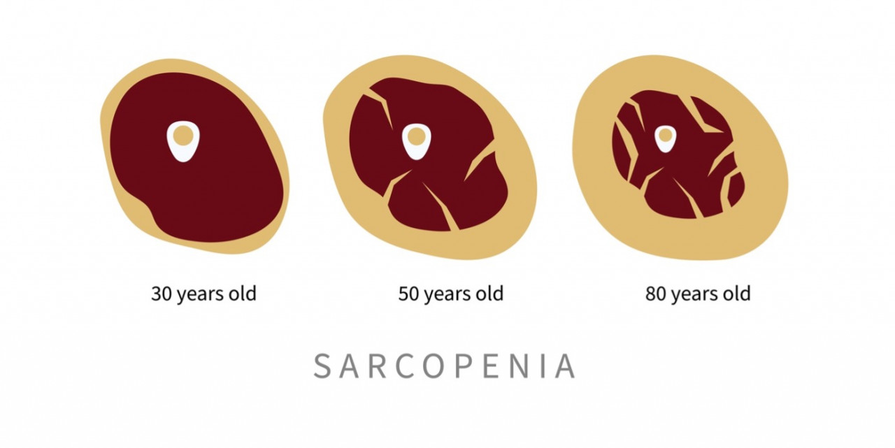 Sarcopenia